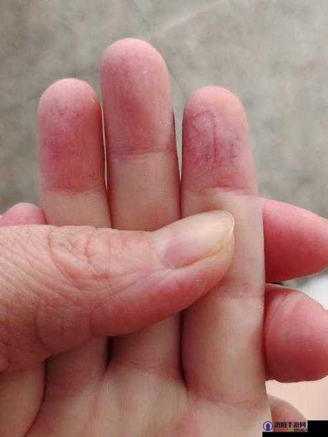 宝宝手指痛为何仅三根手指如此异常呢