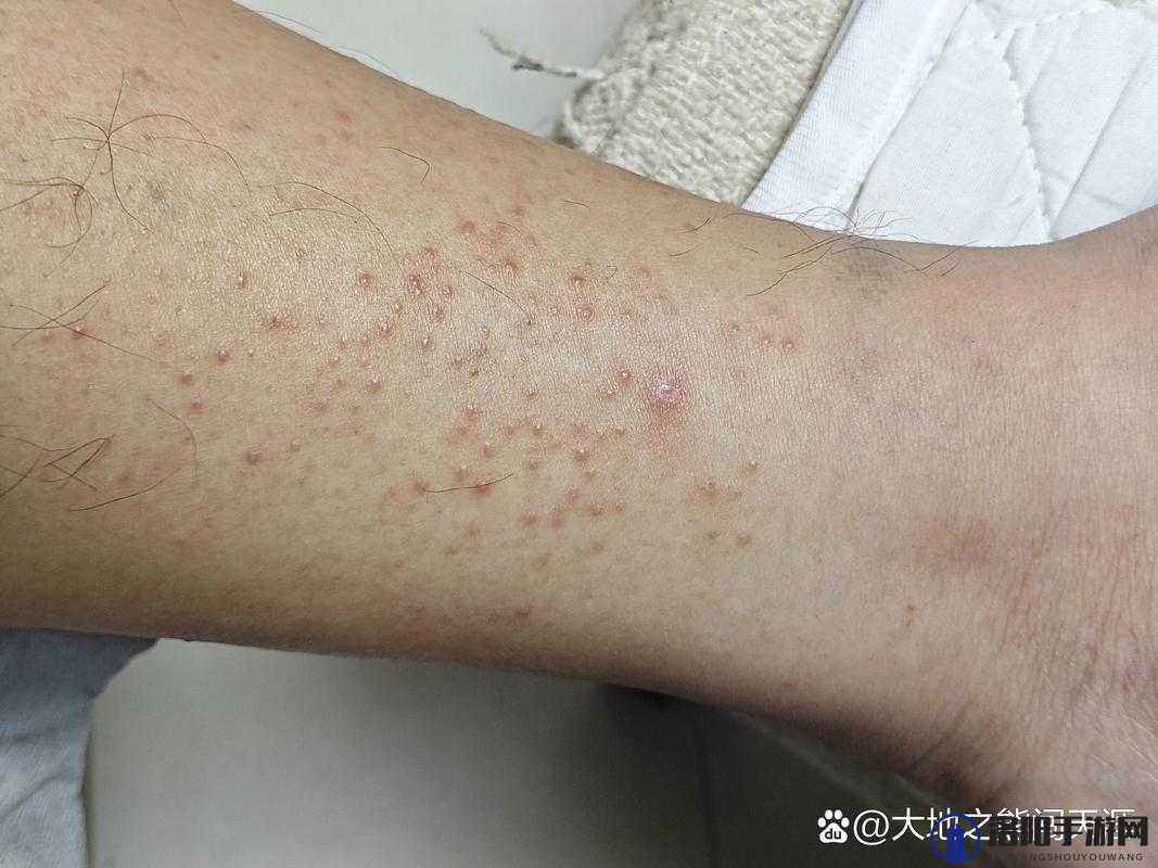 ：令人难以忍受的瘙痒：淑芬两腿中间又痒了