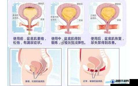 3d 生物束带紧缩术能维持几年：效果影响因素与个体差异分析