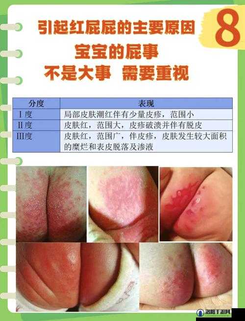 为什么屁股被打后会红肿？如何快速消除屁股上的红肿？